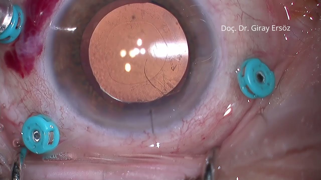 Makula Deliği için Vitrektomi Ameliyatının Yapılışı