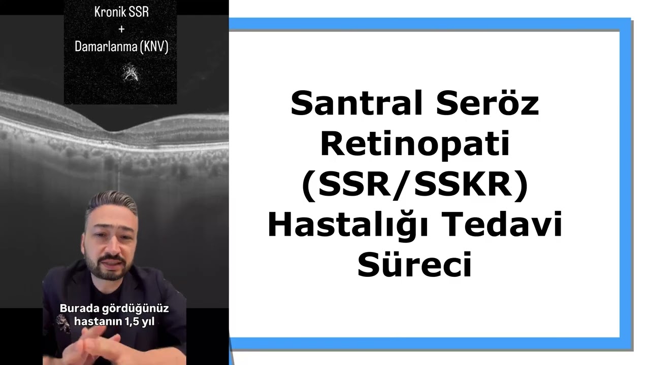 Santral Seröz Retinopati (SSR/SSKR) Hastalığı Tedavi Süreci #SSR #santralserözretinopati