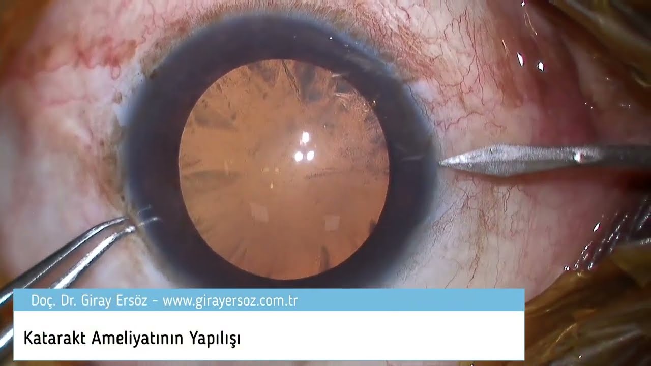 Katarakt Ameliyatının Yapılışı Görüntüleri! | Adım Adım Katarakt Ameliyatı Yapılışı