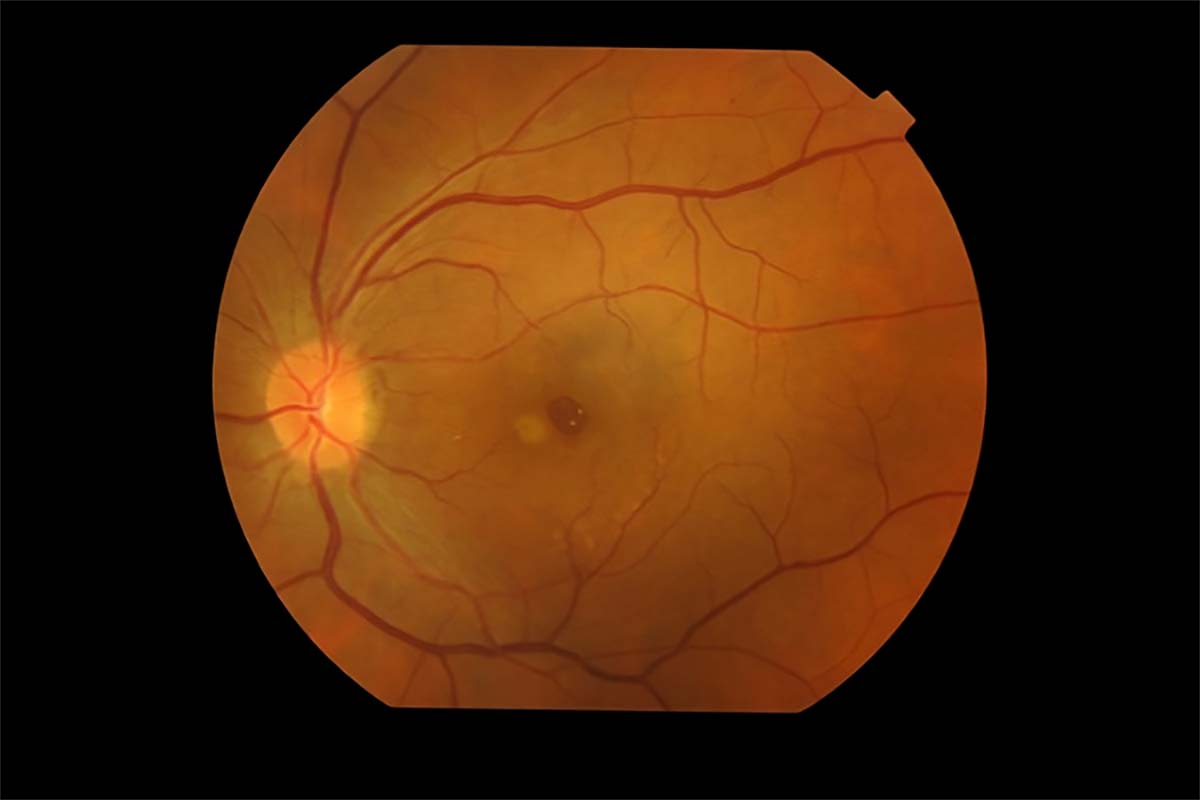 What is a Macular Hole? What are Macular Hole Symptoms and Treatment?