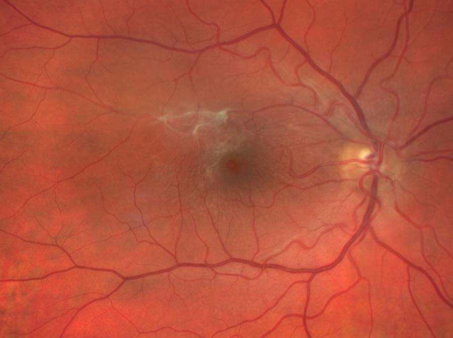 Epiretinal Membrane (ERM) - Symptoms, Diagnosis, and Treatment