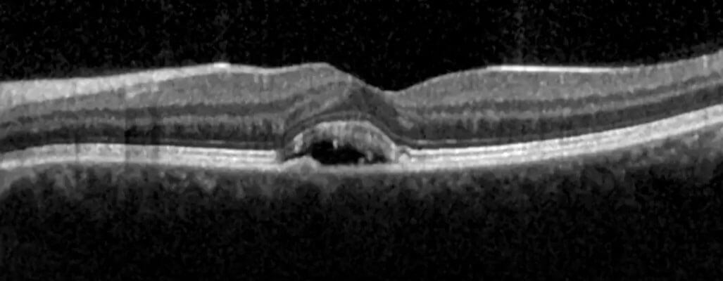 Central Serous Retinopathy