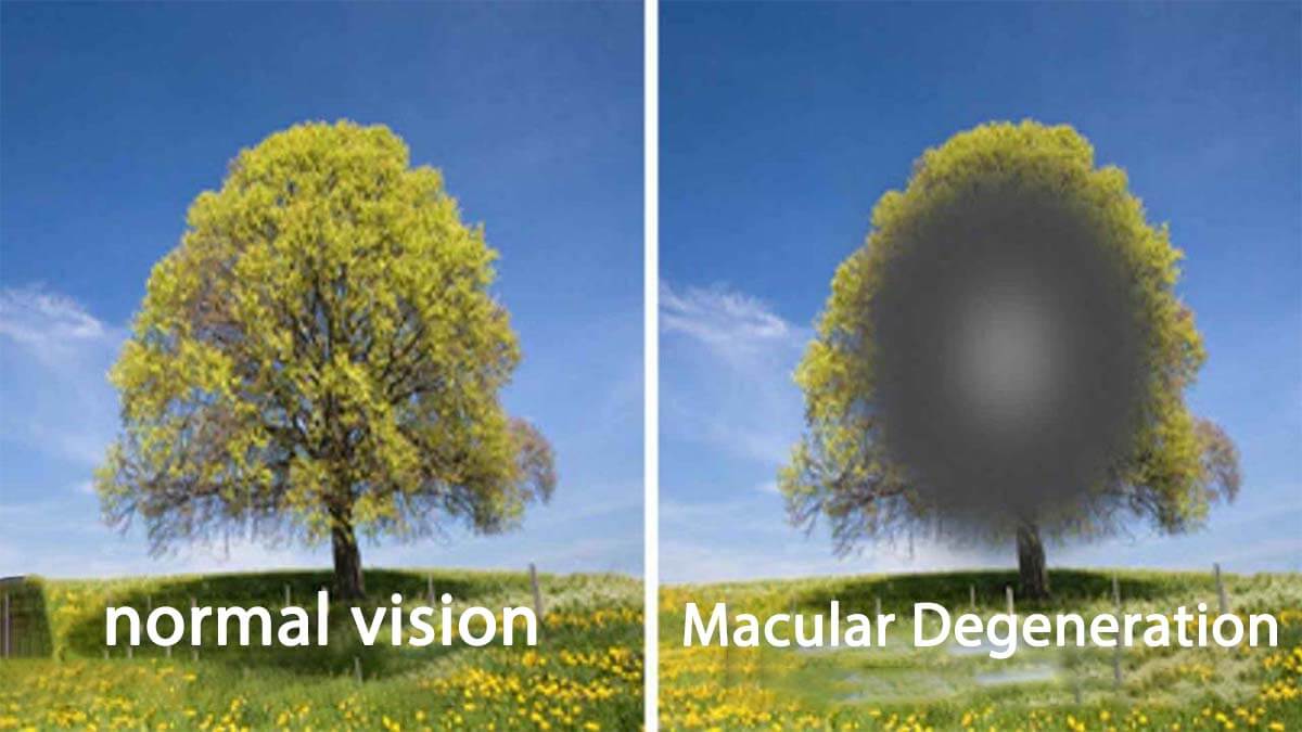 Diagnosis of Macular Disease