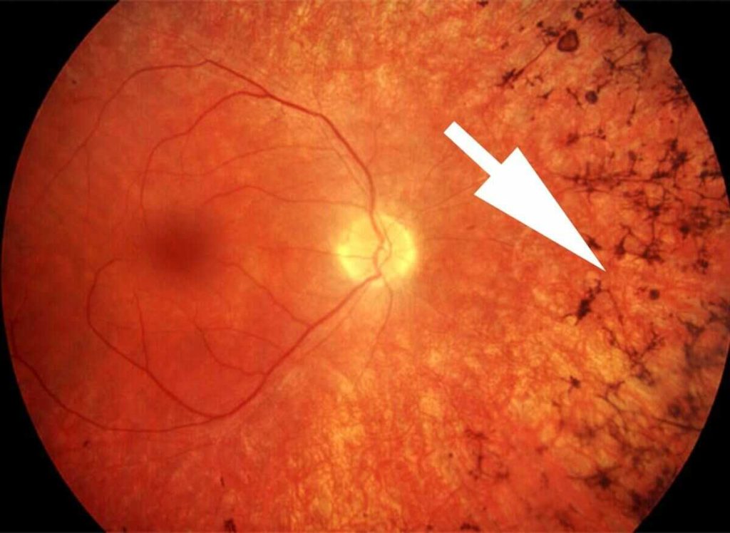 What is Night Blindness (Retinitis Pigmentosa), Symptoms and Treatments