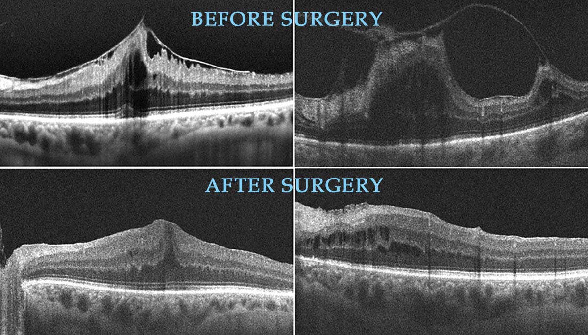 Understanding Vitreomacular Traction Syndrome (VMT)