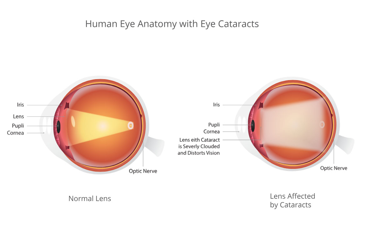 Understanding Cataracts: Causes, Symptoms, Progression, and Treatment?