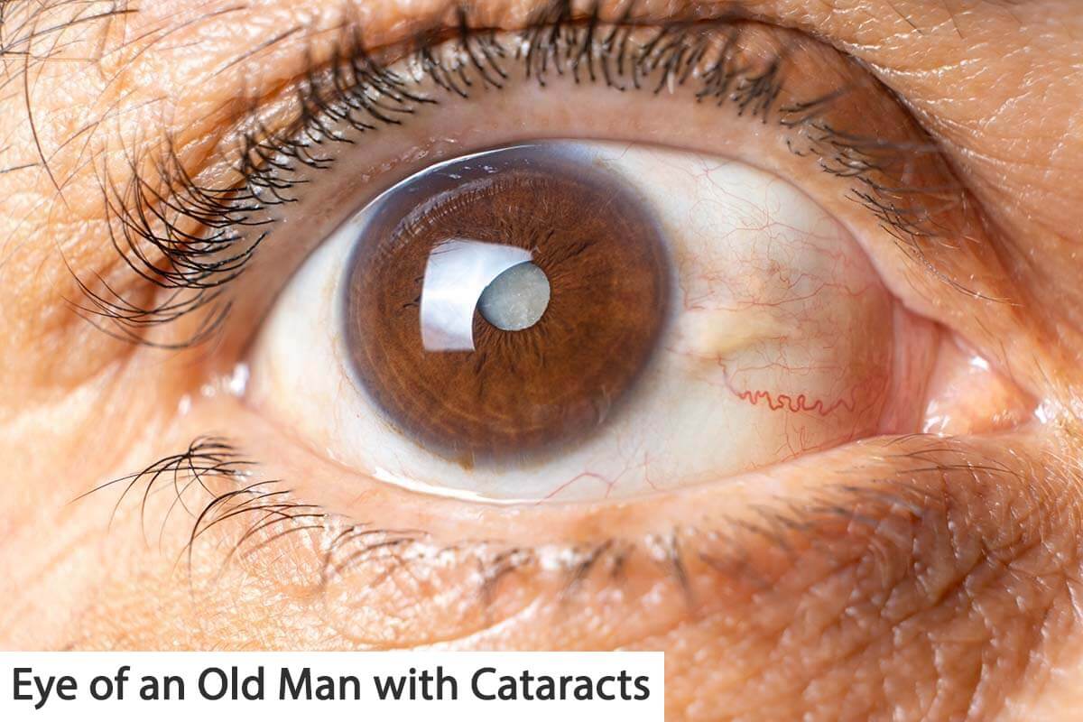 Eye of an Old Man with Cataracts