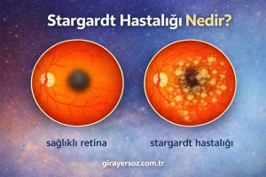 Stargardt Hastalığı Nedir? Belirtileri ve Tedavisi