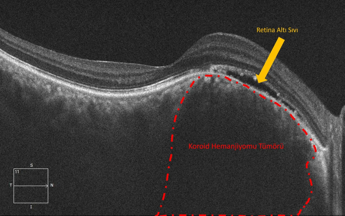 Tedavi öncesi koroid hemanjiyomu