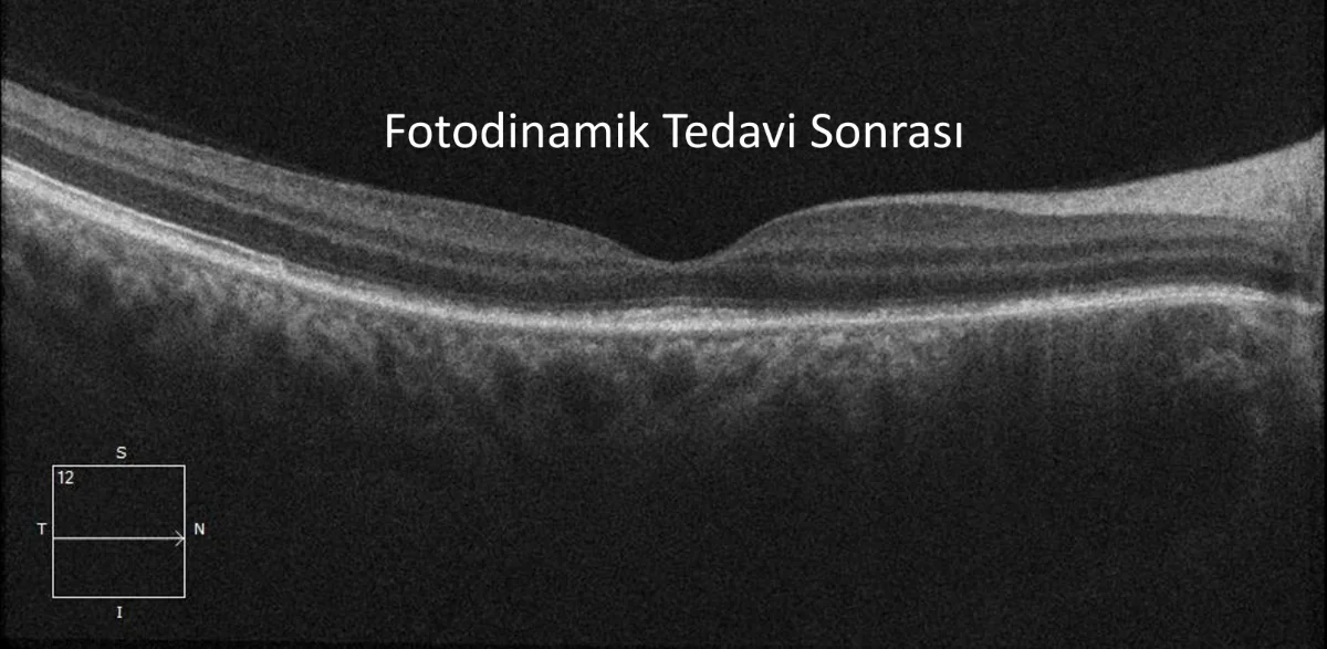 fotodinamik tedavi sonrası koroid hemanjiyomu