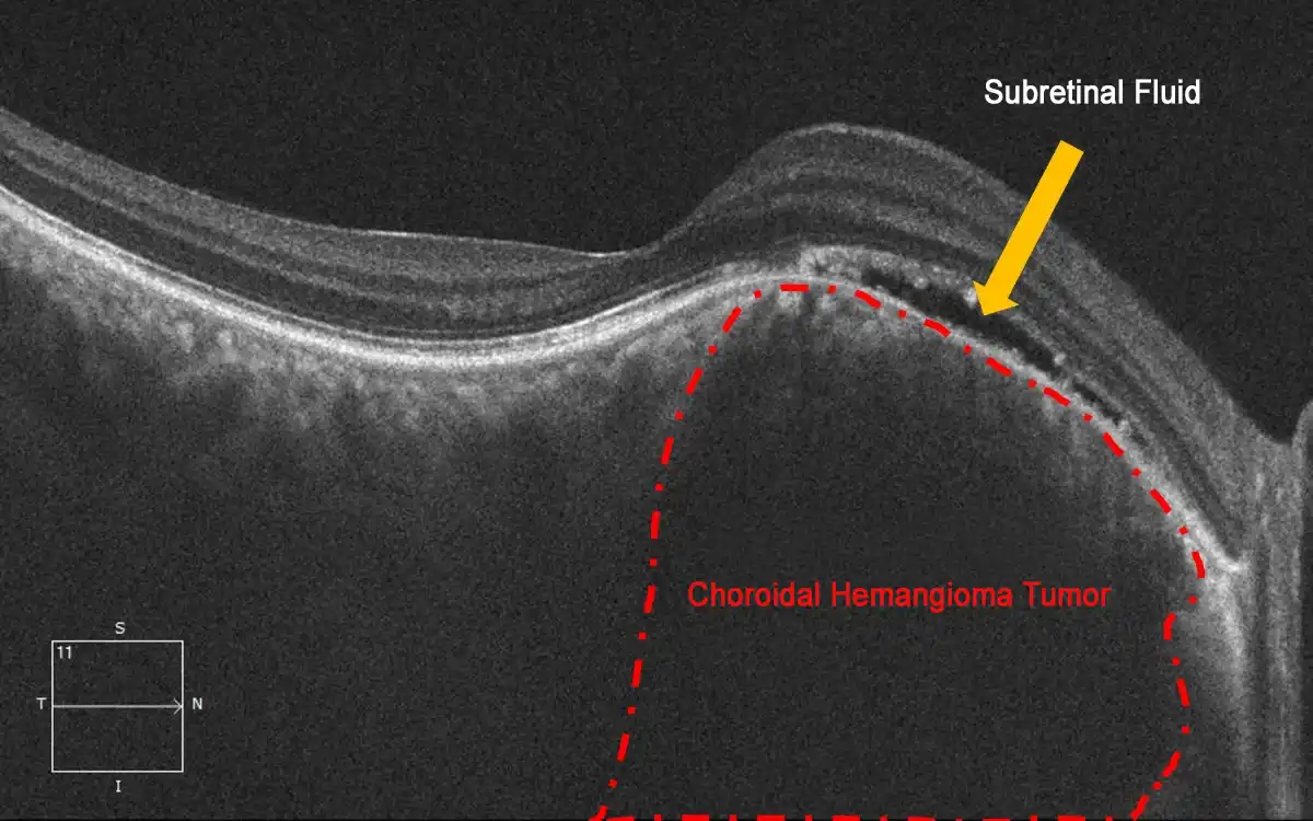 Choroidal Hemangioma Before Treatment