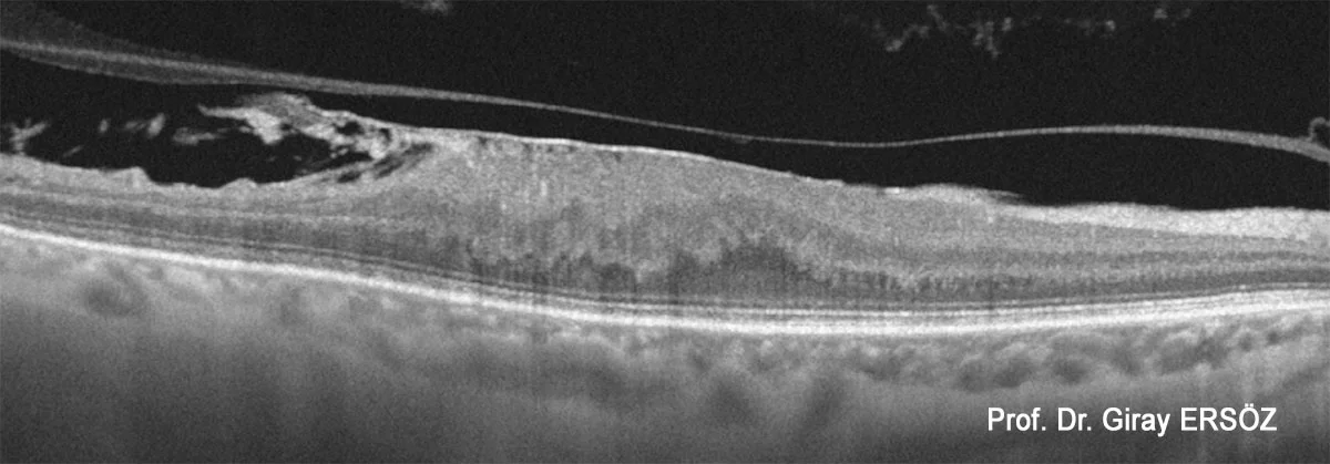 Epiretinal Membran (ERM) Ameliyat Öncesi (Preoperatif)
