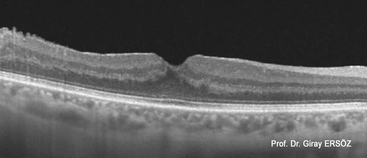 Epiretinal Membran (ERM) Vitrektomi Ameliyatı Sonrası (Postoperatif)